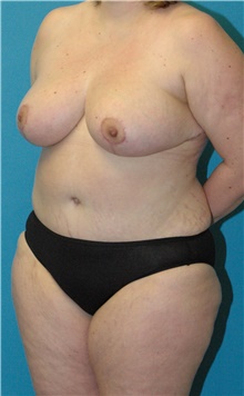 Mommy Makeover After Photo by Scott Sattler, MD,  FACS; Seattle, WA - Case 47058