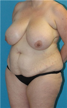 Mommy Makeover Before Photo by Scott Sattler, MD,  FACS; Seattle, WA - Case 47058