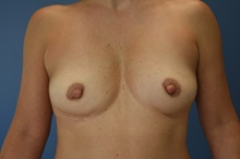 Breast Implant Removal After Photo by Derek Cody, MD, FACS; ,  - Case 47180