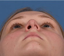 Rhinoplasty Before Photo by Christopher Derderian, MD; ,  - Case 47668