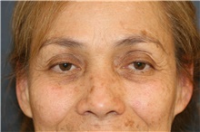 Eyelid Surgery Before Photo by Steve Laverson, MD, FACS; Rancho Santa Fe, CA - Case 47689