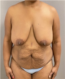Mommy Makeover Before Photo by Keshav Magge, MD; Bethesda, MD - Case 48022