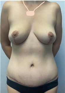 Mommy Makeover After Photo by Owen Reid, MD; Richmond, BC - Case 48369