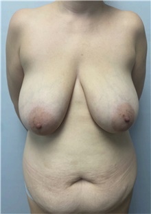 Mommy Makeover Before Photo by Owen Reid, MD; Richmond, BC - Case 48369