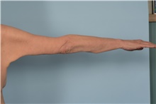 Arm Lift After Photo by Ellen Janetzke, MD; Bloomfield Hills, MI - Case 48388