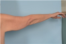 Arm Lift Before Photo by Ellen Janetzke, MD; Bloomfield Hills, MI - Case 48388