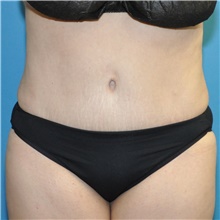Tummy Tuck After Photo by Joshua Cooper, MD; Seattle, WA - Case 48481