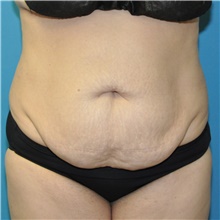 Tummy Tuck Before Photo by Joshua Cooper, MD; Seattle, WA - Case 48481