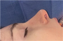 Rhinoplasty Before Photo by Mark Markarian, MD, MSPH, FACS; Wellesley, MA - Case 48540