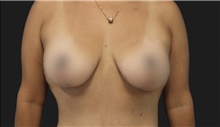Breast Lift After Photo by Munique Maia, MD; Tysons Corner, VA - Case 48719