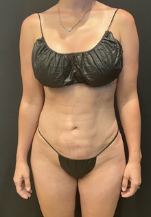 Liposuction After Photo by Johnny Franco, MD; ,  - Case 48784