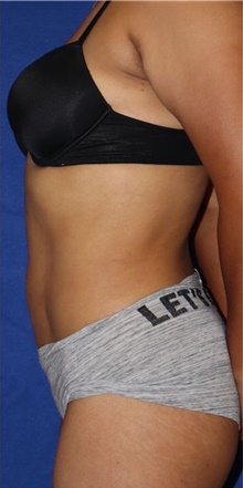 Liposuction After Photo by Munique Maia, MD; Tysons Corner, VA - Case 48950