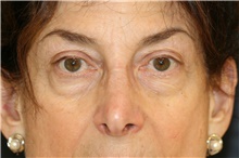 Eyelid Surgery Before Photo by Steve Laverson, MD, FACS; Rancho Santa Fe, CA - Case 49243