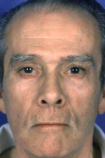Eyelid Surgery After Photo by Bahman Guyuron, MD; Cleveland, OH - Case 8381