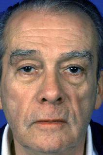 Eyelid Surgery Before Photo by Bahman Guyuron, MD; Cleveland, OH - Case 8381
