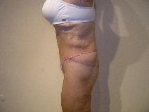 Body Contouring After Photo by Joseph Fodero, MD; Florham Park, NJ - Case 9089