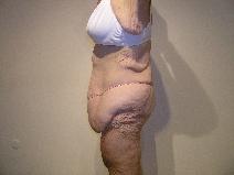 Body Contouring Before Photo by Joseph Fodero, MD; Florham Park, NJ - Case 9089