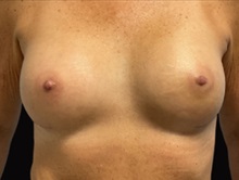Breast Augmentation After Photo by Julia Spears, MD, FACS; Marlton, NJ - Case 50354