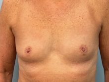 Breast Augmentation Before Photo by Julia Spears, MD, FACS; Marlton, NJ - Case 50354