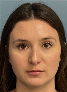 Rhinoplasty Before Photo by Pramit Malhotra, MD; Ann Arbor, MI - Case 50403