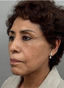 Facelift After Photo by Keshav Magge, MD; Bethesda, MD - Case 50516