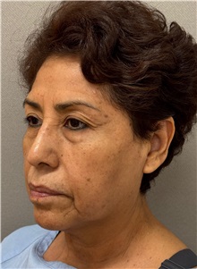 Facelift Before Photo by Keshav Magge, MD; Bethesda, MD - Case 50516