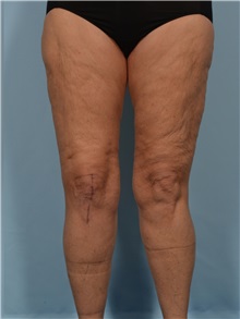Thigh Lift After Photo by Ellen Janetzke, MD; Bloomfield Hills, MI - Case 50534