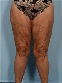 Thigh Lift Before Photo by Ellen Janetzke, MD; Bloomfield Hills, MI - Case 50534