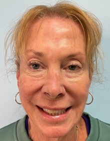Dermal Fillers After Photo by Julia Spears, MD, FACS; Marlton, NJ - Case 50560