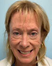 Dermal Fillers Before Photo by Julia Spears, MD, FACS; Marlton, NJ - Case 50560