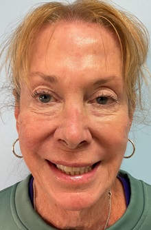 Botulinum Toxin After Photo by Julia Spears, MD, FACS; Marlton, NJ - Case 50558
