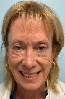 Botulinum Toxin Before Photo by Julia Spears, MD, FACS; Marlton, NJ - Case 50558