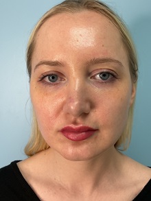 Dermal Fillers After Photo by Julia Spears, MD, FACS; Marlton, NJ - Case 50631