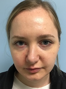 Dermal Fillers Before Photo by Julia Spears, MD, FACS; Marlton, NJ - Case 50631