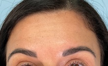 Botulinum Toxin After Photo by Julia Spears, MD, FACS; Marlton, NJ - Case 50721