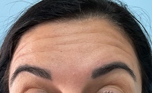 Botulinum Toxin Before Photo by Julia Spears, MD, FACS; Marlton, NJ - Case 50721