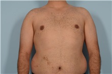 Male Breast Reduction After Photo by Ellen Janetzke, MD; Bloomfield Hills, MI - Case 49870