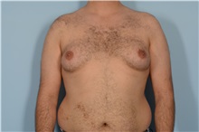 Male Breast Reduction Before Photo by Ellen Janetzke, MD; Bloomfield Hills, MI - Case 49870
