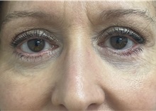 Eyelid Surgery After Photo by Franklin Richards, MD; ,  - Case 50065
