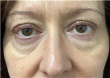 Eyelid Surgery Before Photo by Franklin Richards, MD; ,  - Case 50065