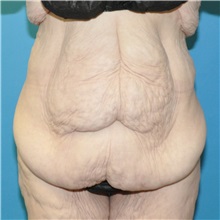 Body Lift Before Photo by Joshua Cooper, MD; Seattle, WA - Case 50083