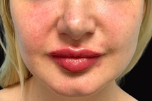 Dermal Fillers After Photo by Julia Spears, MD, FACS; Marlton, NJ - Case 50232
