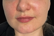 Dermal Fillers Before Photo by Julia Spears, MD, FACS; Marlton, NJ - Case 50232