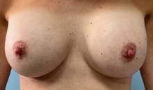 Breast Augmentation After Photo by Julia Spears, MD, FACS; Marlton, NJ - Case 49309