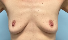 Breast Augmentation Before Photo by Julia Spears, MD, FACS; Marlton, NJ - Case 49309