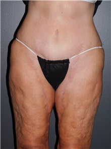Thigh Lift Before Photo by Michele DeVito, MD, FACS; Scottsdale, AZ - Case 49666