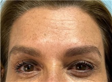 Botulinum Toxin After Photo by Julia Spears, MD, FACS; Marlton, NJ - Case 49818