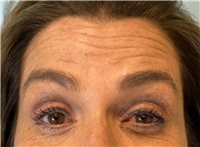 Botulinum Toxin Before Photo by Julia Spears, MD, FACS; Marlton, NJ - Case 49818