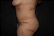 Tummy Tuck After Photo by Susan Kaweski, MD; La Mesa, CA - Case 49815