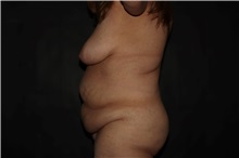 Tummy Tuck Before Photo by Susan Kaweski, MD; La Mesa, CA - Case 49815